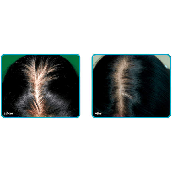 DAENG GI MEO RI Средство против выпадения волос интенсивного действия Vitalizing Scalp Nutrition Pack for Hair-loss (145 мл)